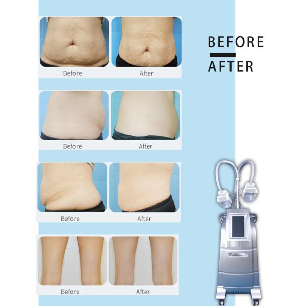 Professional cryo fat beauty machine fatest slimming weight loss cryo equipment LF-207B