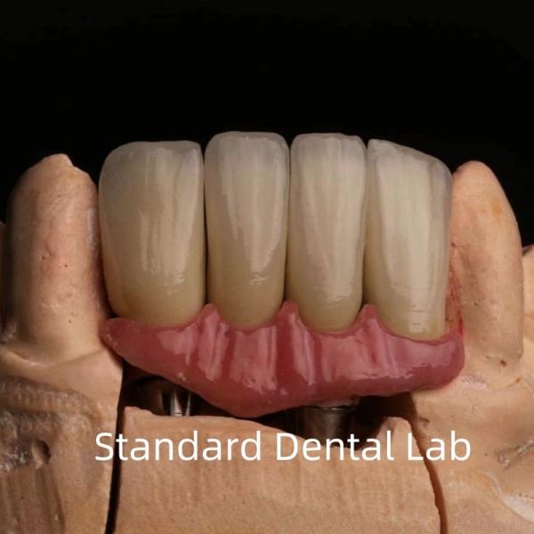 Porcelaine dentaire couronne d'implant de zirconium haute esthétique professionnelle