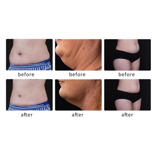 4 Cryo Handles Cryolipolysis Slimming Machine For Body Cellulite Treatment