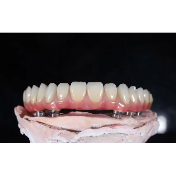 Multi Unit Abutment Titanium Alloy Zirconia Bridge Dental Implant Durable Prosthesis