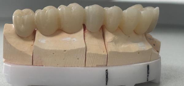 Full Zirconia Bridge with 1200 MPa Strength High Translucency and Metal-Free for Superior Dental Restorations