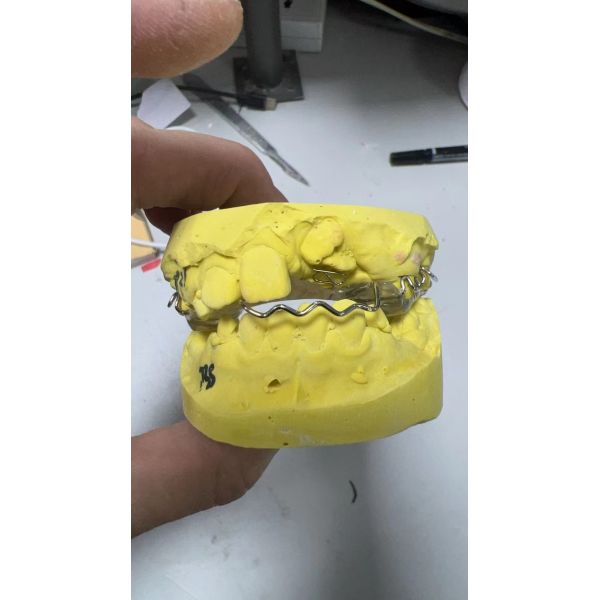 Custom Fit Orthodontic Facemask with Palatal Springs and Adjustable Design