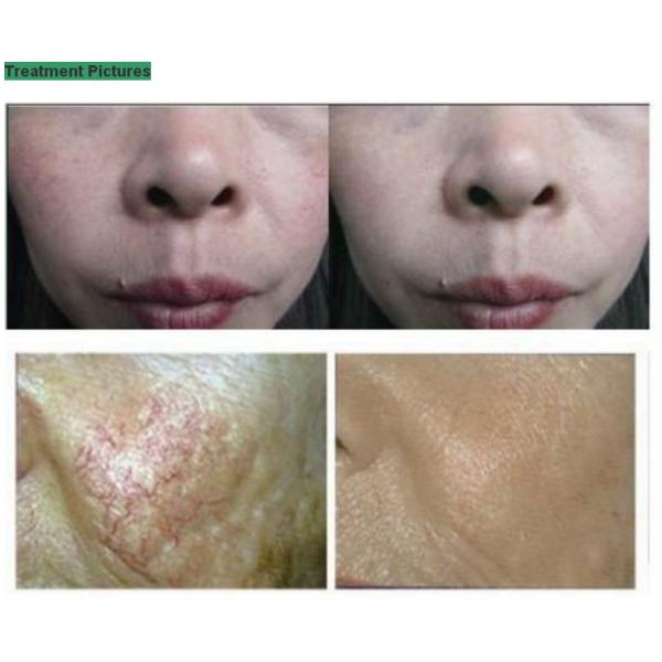 980nm medical diode laser spider vein removal machine/980nm laser vascular vein removal