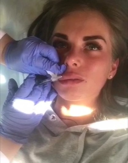 Cross Linked Dermal Lip Fillers 2ml , Hyaluronic Acid Gel For Lip Plumper