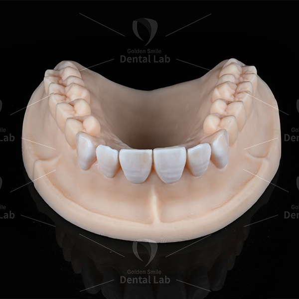 Non Prep Diagnostic Wax Up For Veneers Rehab Full Mouth Wax Up