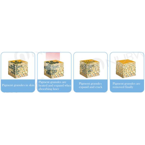 Hot Q-switched Nd-yag Laser Tattoo Machine/ 1064nm 532nm Mole Skin Tag Removal & Tattoo