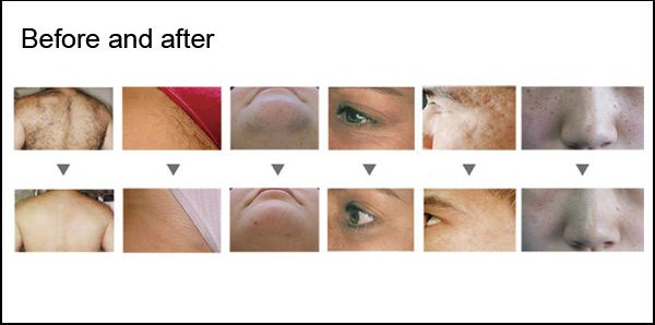 Удаление татуировки IPL лицевое 3000w Picolaser машины удаления волос Elight SHR