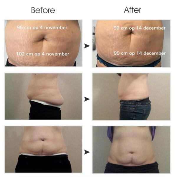 Safety 5 Cryo Handles Body Slimming Equipment For Double Chin CE / FDA Approved