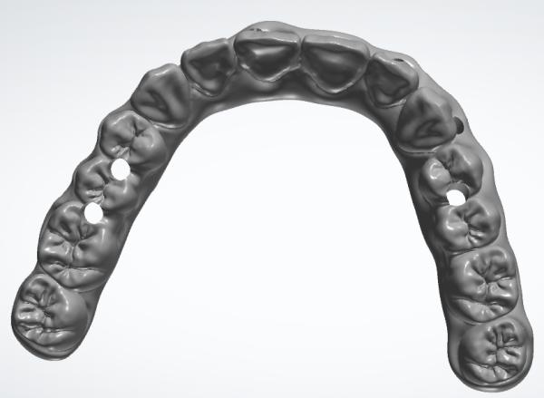 Digital Aluminum Bar with Temporary Teeth for Dental Study Models