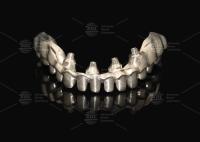 Implantation hybride en porcelaine rose couronne Malong pont d'implantation à pleine voûte chargement immédiat