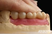 超精密加工 ジルコニアインプラント オールジルコニア一体型クラウン