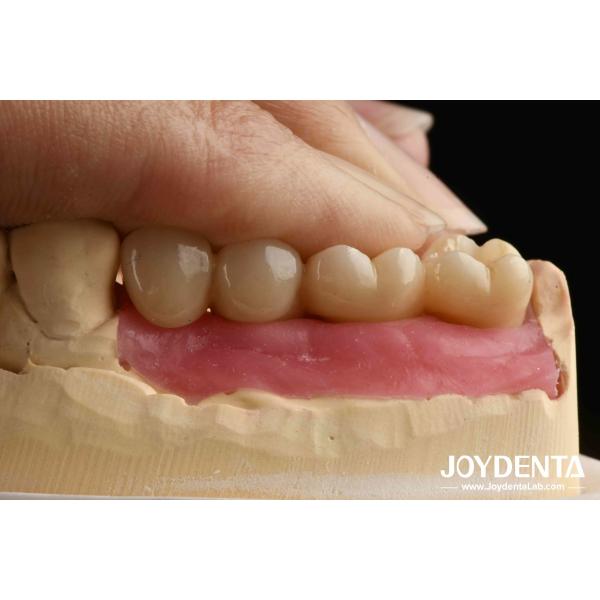 Procesamiento de ultra precisión Implantes de zirconio de todo el zirconio