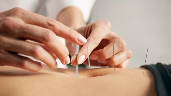 Agujas de acupuntura intradérmica de plata La elección profesional para aplicaciones cosméticas y médicas