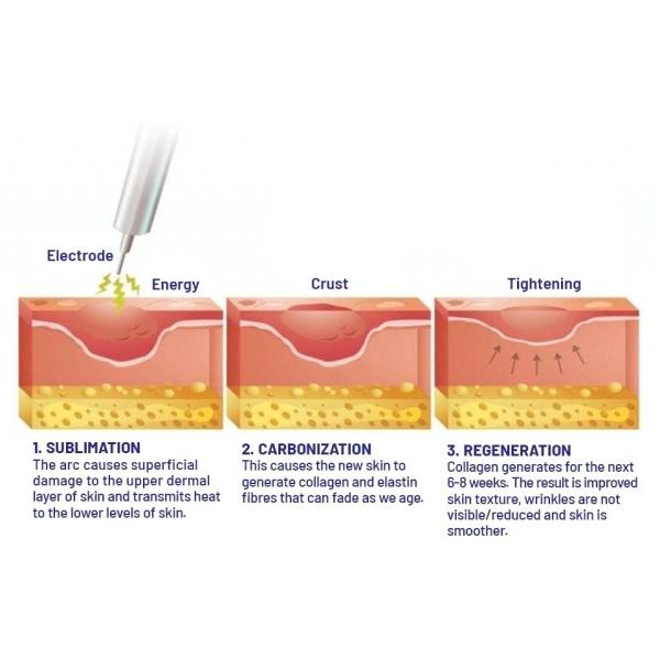 Cool Plasma Machine For Wrinkle Removal Skin Rejuvenation Body Care