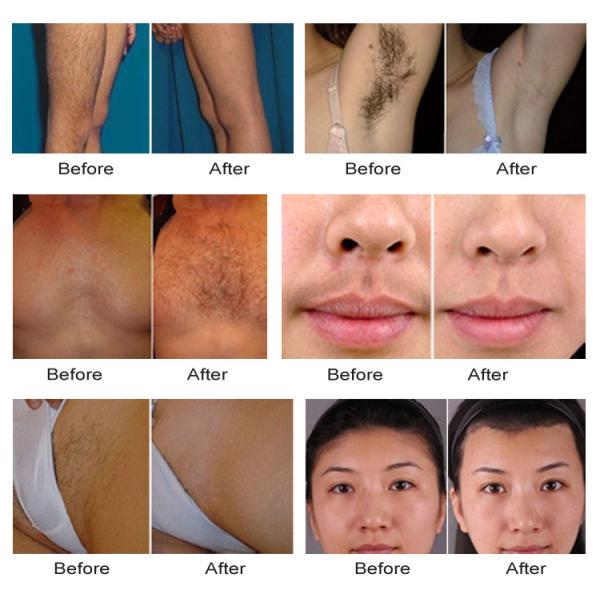 CE Professional Soprano 808nm Diode Laser Epilator , 808nm Diode Laser , 808nm Diode Laser Hair Removal