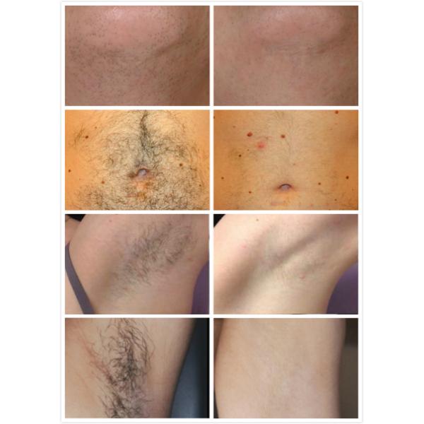 Профессиональная 1200w машина удаления волос лазера наивысшей мощности 808nm для эффективной, безопасной и удобной обработки