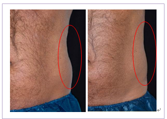 1000W Output Power Cryolipolysis Machine Freezing Slimming Beauty Machine