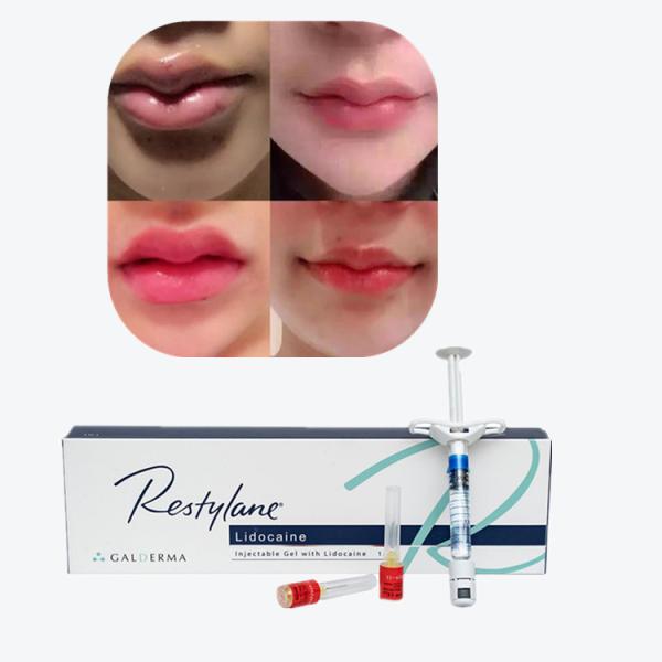 Juvederm Cross Linked Injectable Dermal Filler For Lips