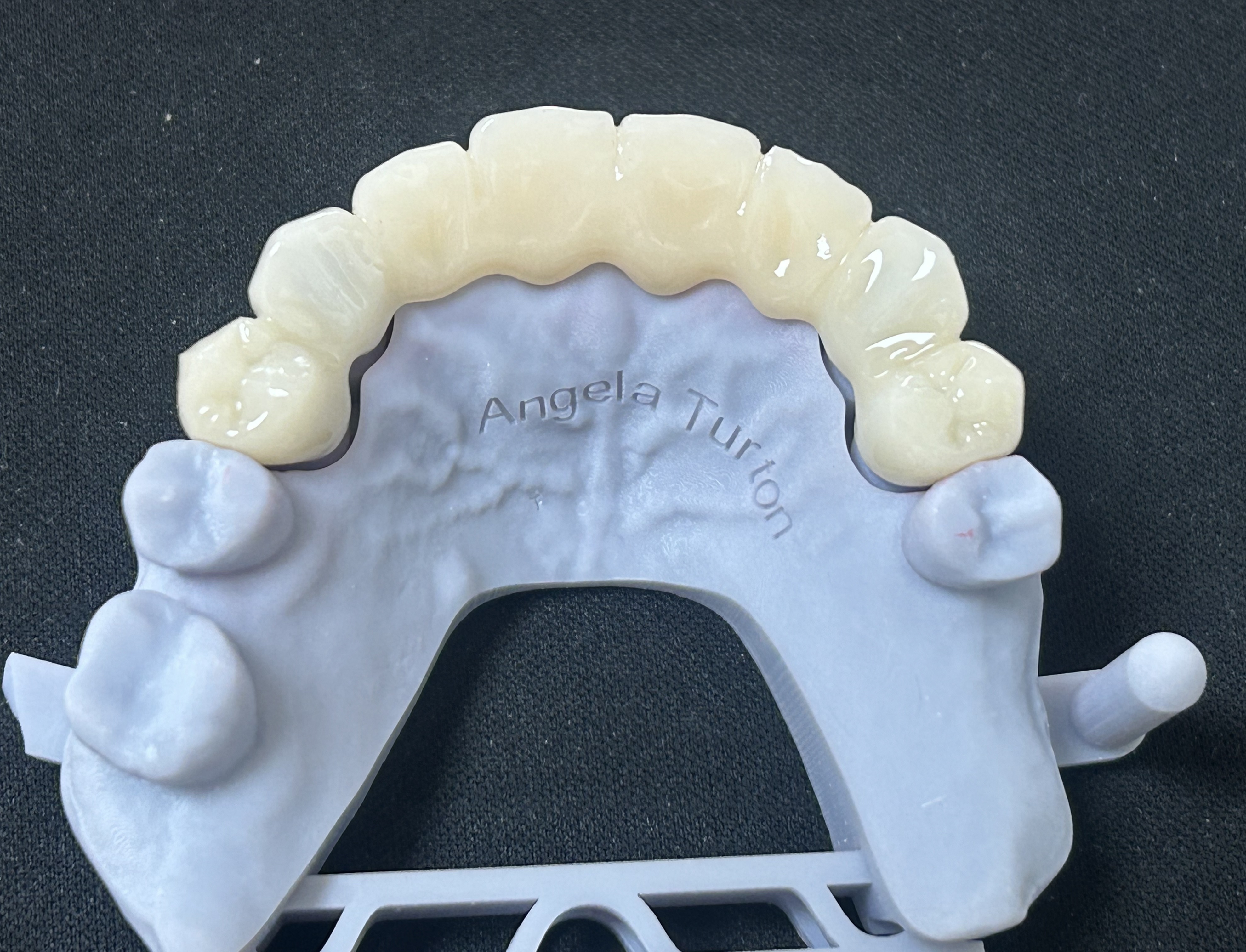 CAD/CAM Digital Design Temporary Dental Bridge with Natural Tooth-Like