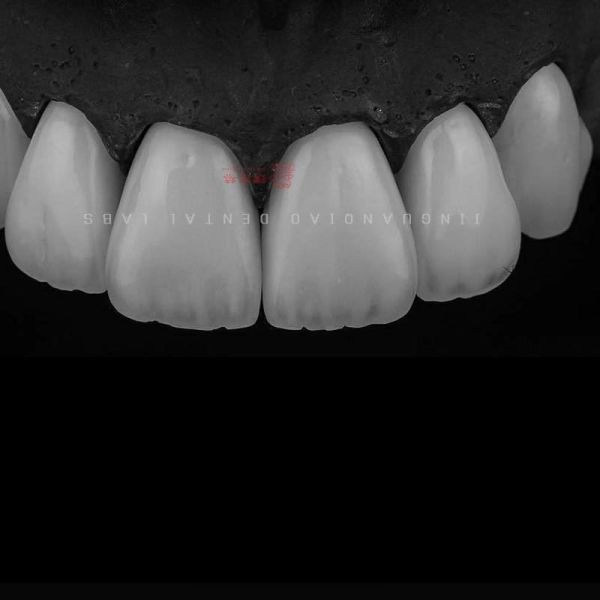 Tooth Like Shells Dental Porcelain Emax Veneers Dsd Design China Dental Lab
