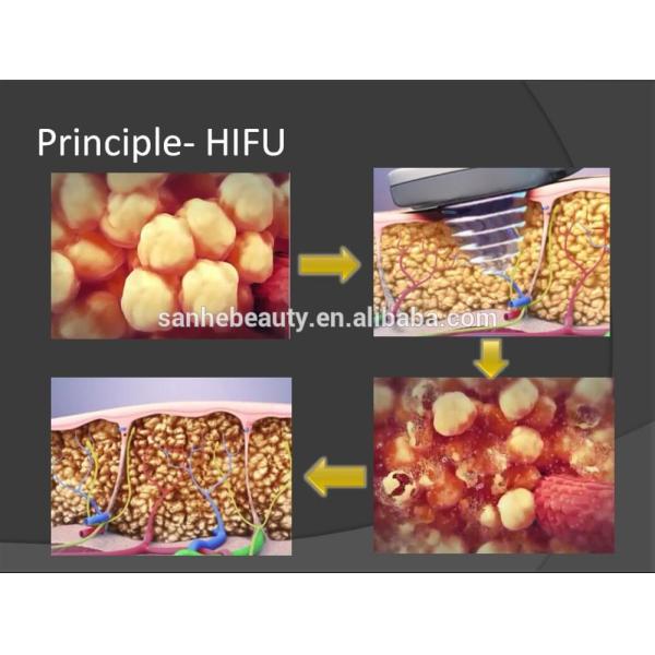 *New product looking for distributor! Hifu slimming machine