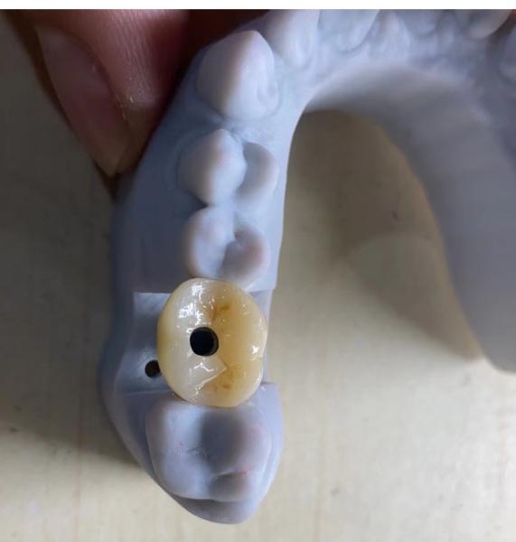 High Precision Implant Supported Crown Stable And Easy Maintenance