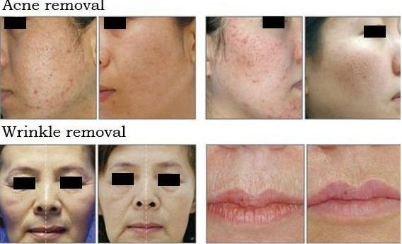 Hot sale 3 handles IPL hair removal machine with surper cooling system handles