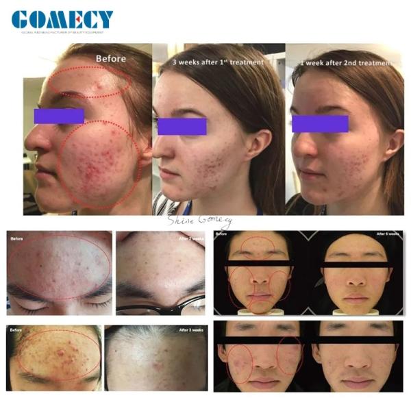 2025 Gomecy Cold Plasma Machine For Skin , Beauty Plasma Lifting Machine