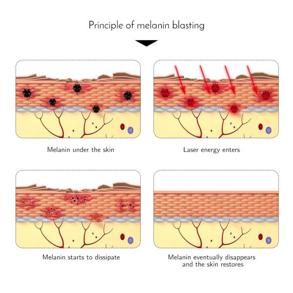 Спа подмолаживания кожи машины удаления татуировки лазера Nd Yag Lasertell коммерчески