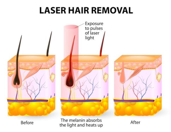 Garantia da máquina 808nm da remoção do cabelo do laser equipamento de uma beleza de 1 ano