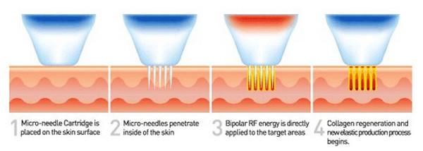 Best Fractional RF microneedle for skin rejuvenation acne removal collagen regeneration frequency 5Hz adjustable