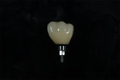 Cylindrical Titanium Zirconia Screw Retained Dental Implant Natural Looking