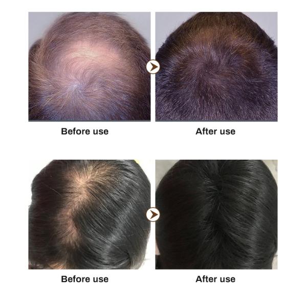 Best Selling Hair Growth Shampoo for Thinning Hair Loss for Women and Men Thicker Longer Hair