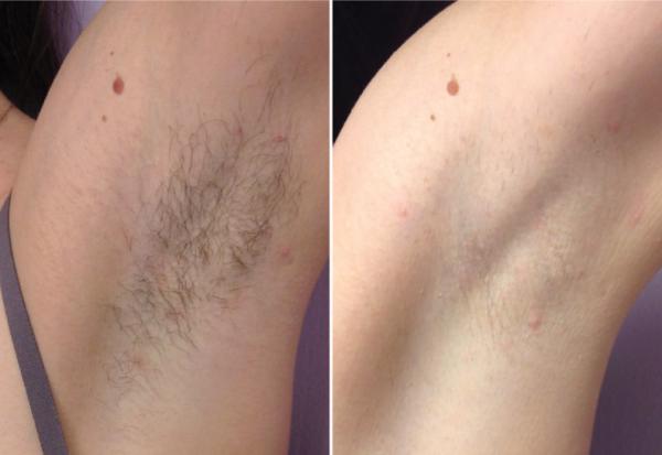 how to remove unwanted hair | ipl Shr super hair removal machine Forimi