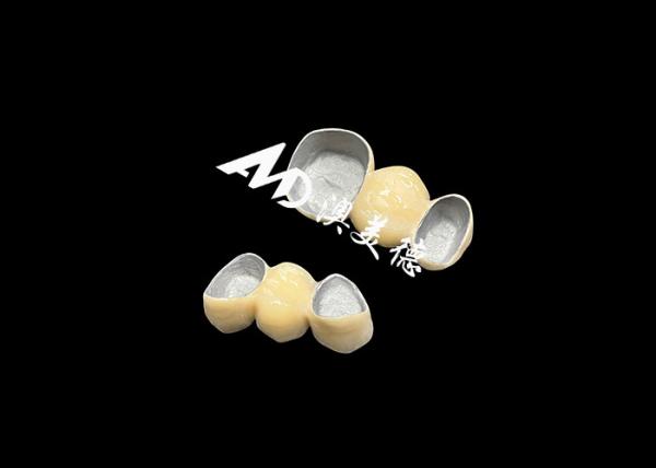 O metal resistente à corrosão da coroa apta da precisão PFM ligou cerâmico