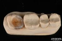 Des incrustations dentaires Emax personnalisées et naturelles pour la restauration des dents