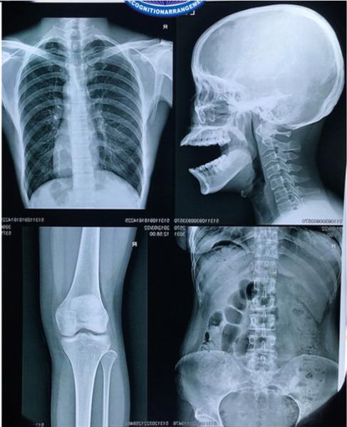 PET Based X Ray Film 8x10 Inch Blue Laser Medical Film For Digital Image Output