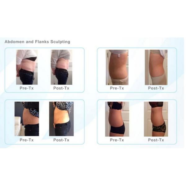 Professional HIFU Machine / Non Surgical Ultrasonic Face Lift Machine For Home