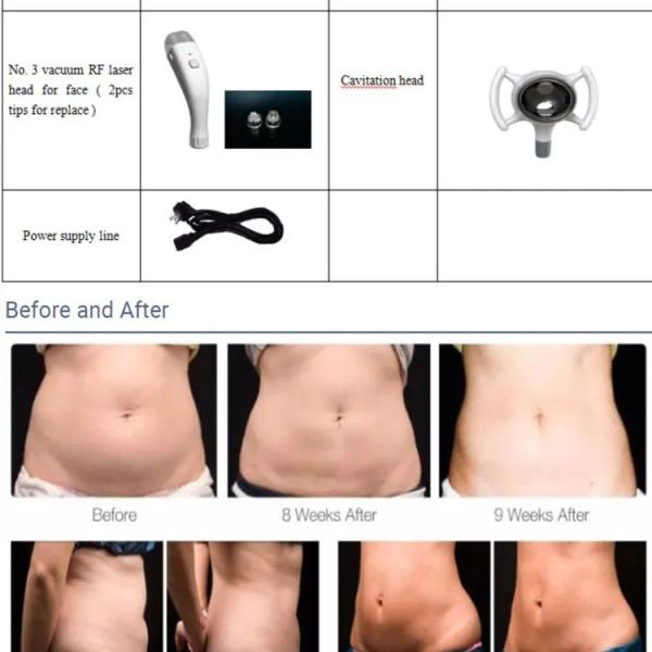 3 In 1 Vela Adjustable Pressure Cryolipolysis Slimming Machine With Powerful Vacuum