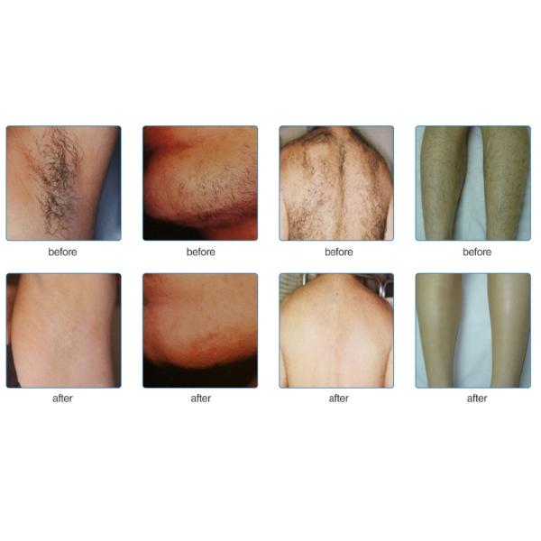 depilação laser vMost advanced hair removal laser /808nm diode laser hair /pianless hair removal laser,lightsheer