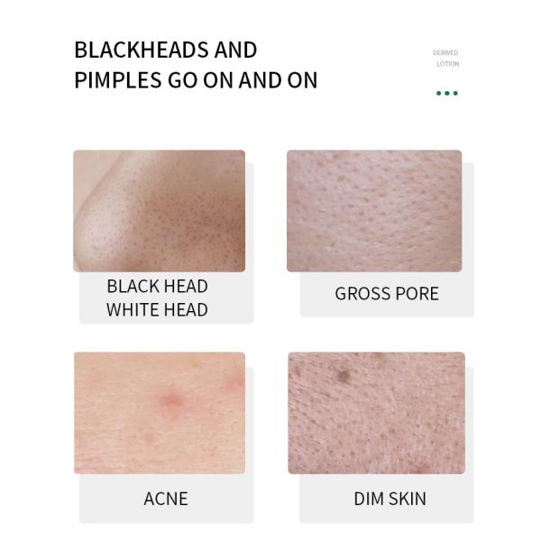 Ablande Lackhead derivó el suero del removedor de la espinilla del suero de la cara de la esencia