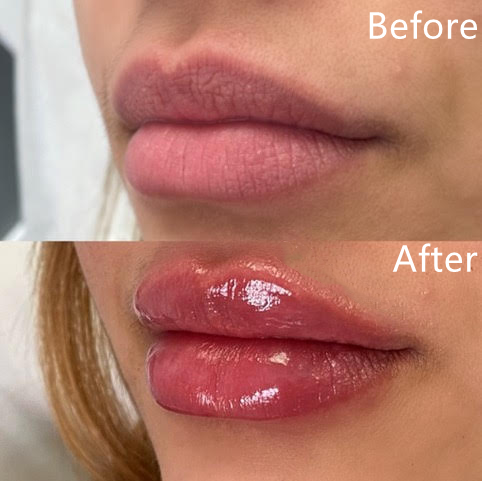 Лучший Juvederm Ultra 3 для увеличения объема губ Dermal Injection Filler Гиалуроновая кислота