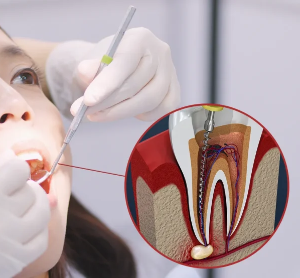 Premixed Calcium Hydroxide Paste with Iodoform - 2g per Syringe Root Canal Filling Material for Primary and Young Permanent Teeth