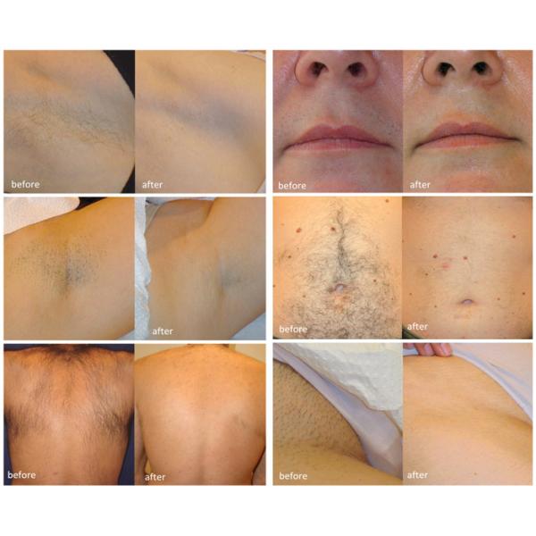 ipl wrinkle removal machine shr for hair removal