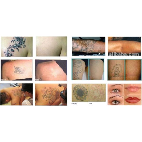 Picosecond Laser 1064nm 532nm Pico Q Switched Nd Yag Laser for Tattoo Removal Machine