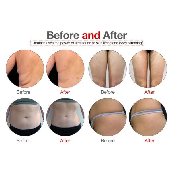 350MW 6 в 1 лазере кавитации 40K Lipo уменьшая вакуум RF машины