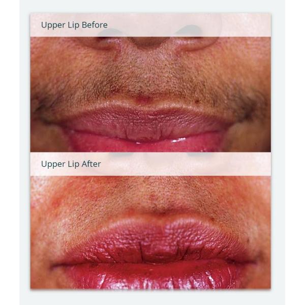 2000w 950nm Permanent IPL Hair Removal Machine