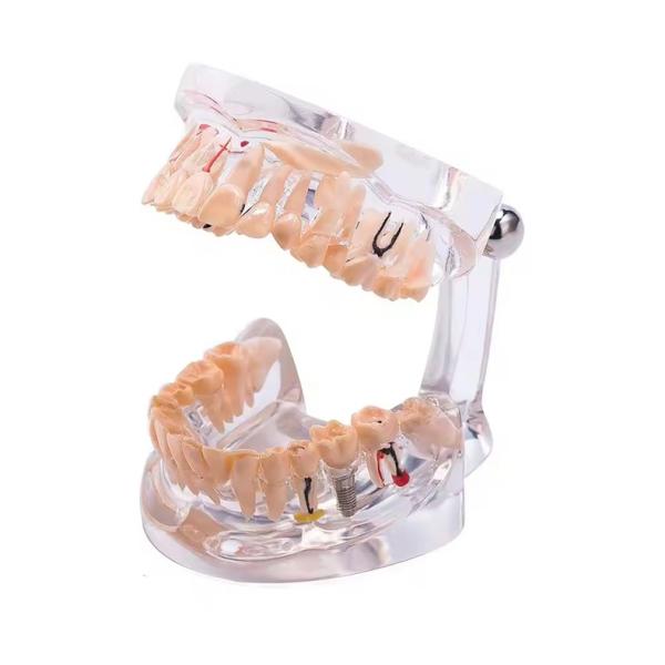 32 Tooth Full Month Implant Disease Teeth Model Clear Design  Dental Pathology Model