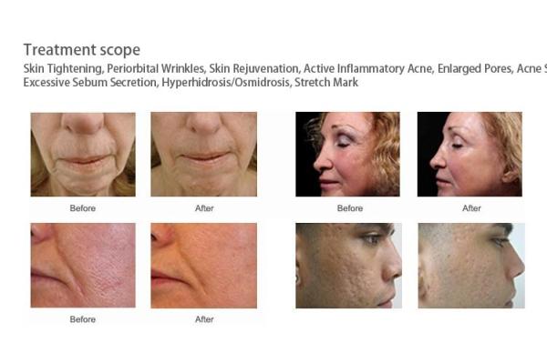 All skin problem solution! scarlet rf needle machine fractional rf microneedle machine
