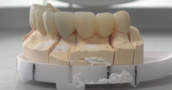 Full Zirconia Bridge with 1200 MPa Strength High Translucency and Metal-Free for Superior Dental Restorations
